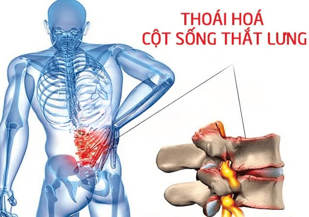 5 MỐI NGUY TỪ CÁC CƠN ĐAU THẮT LƯNG 1