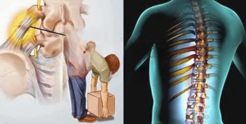 5 MỐI NGUY TỪ CÁC CƠN ĐAU THẮT LƯNG 2