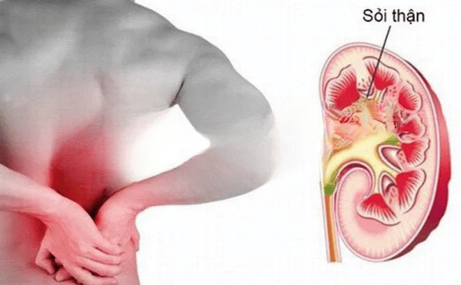 5 MỐI NGUY TỪ CÁC CƠN ĐAU THẮT LƯNG 3