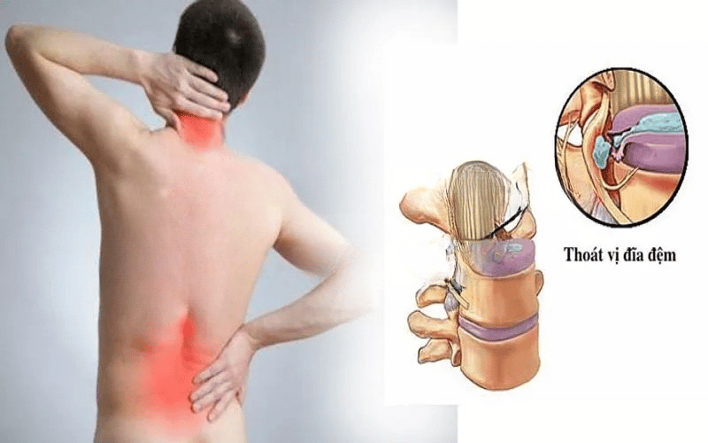 5 MỐI NGUY TỪ CÁC CƠN ĐAU THẮT LƯNG 4