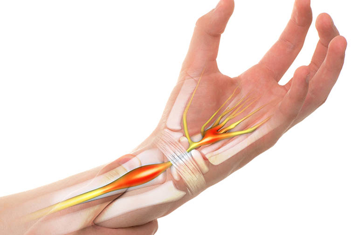 Tê tay chân có ảnh hưởng gì không? 1