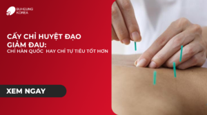 Minh họa cấy chỉ hàn quốc hay chỉ tự tiêu tốt hơn