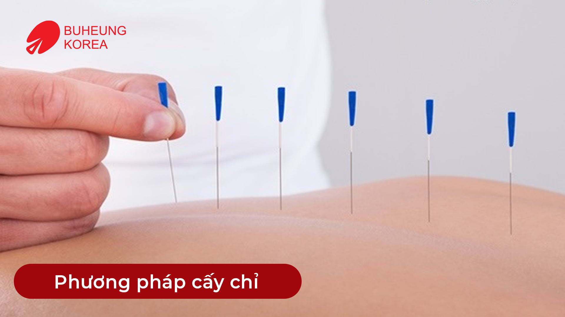 Minh họa phương pháp cấy chỉ