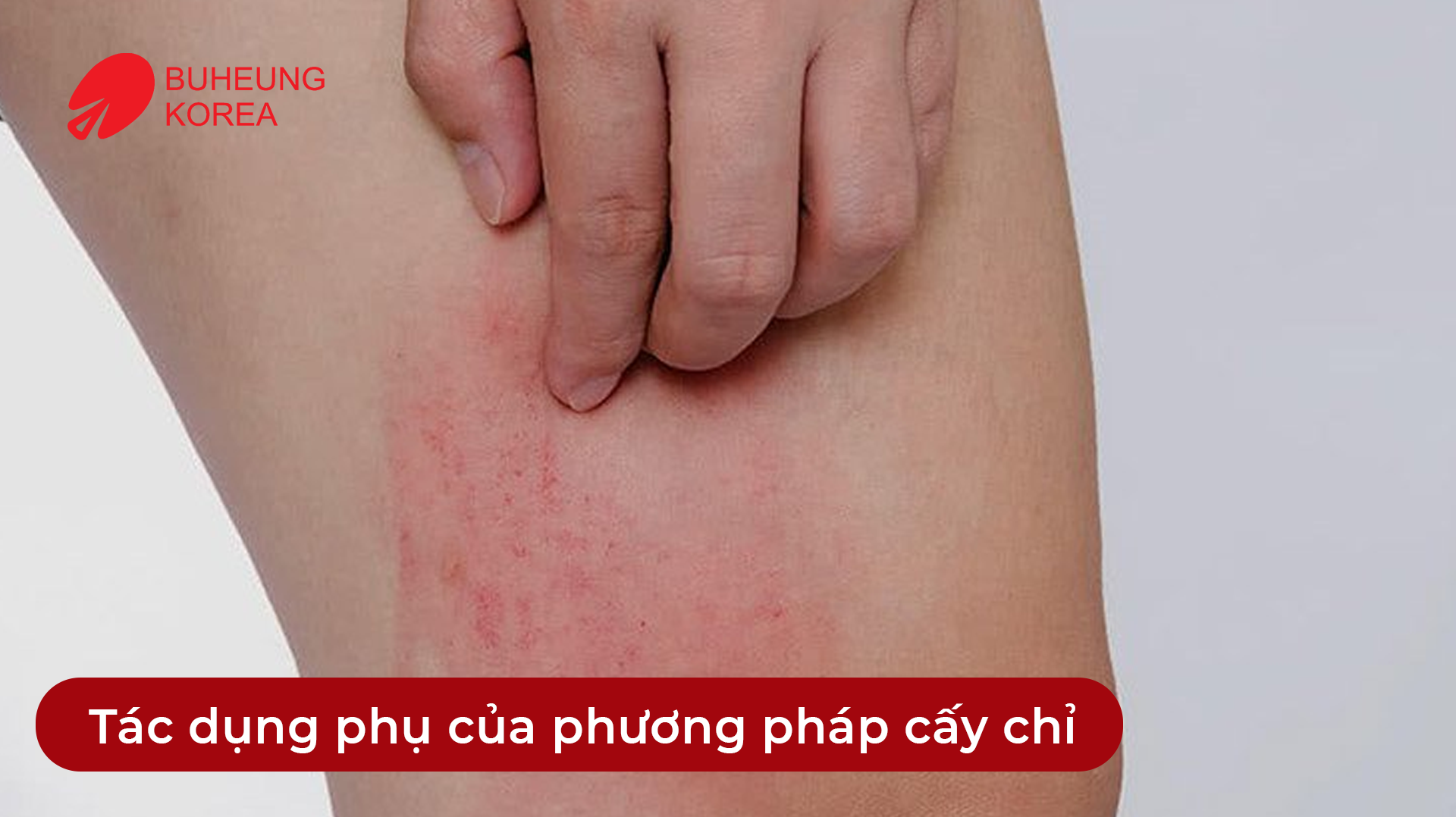 Minh họa tác dụng phụ cấy chỉ
