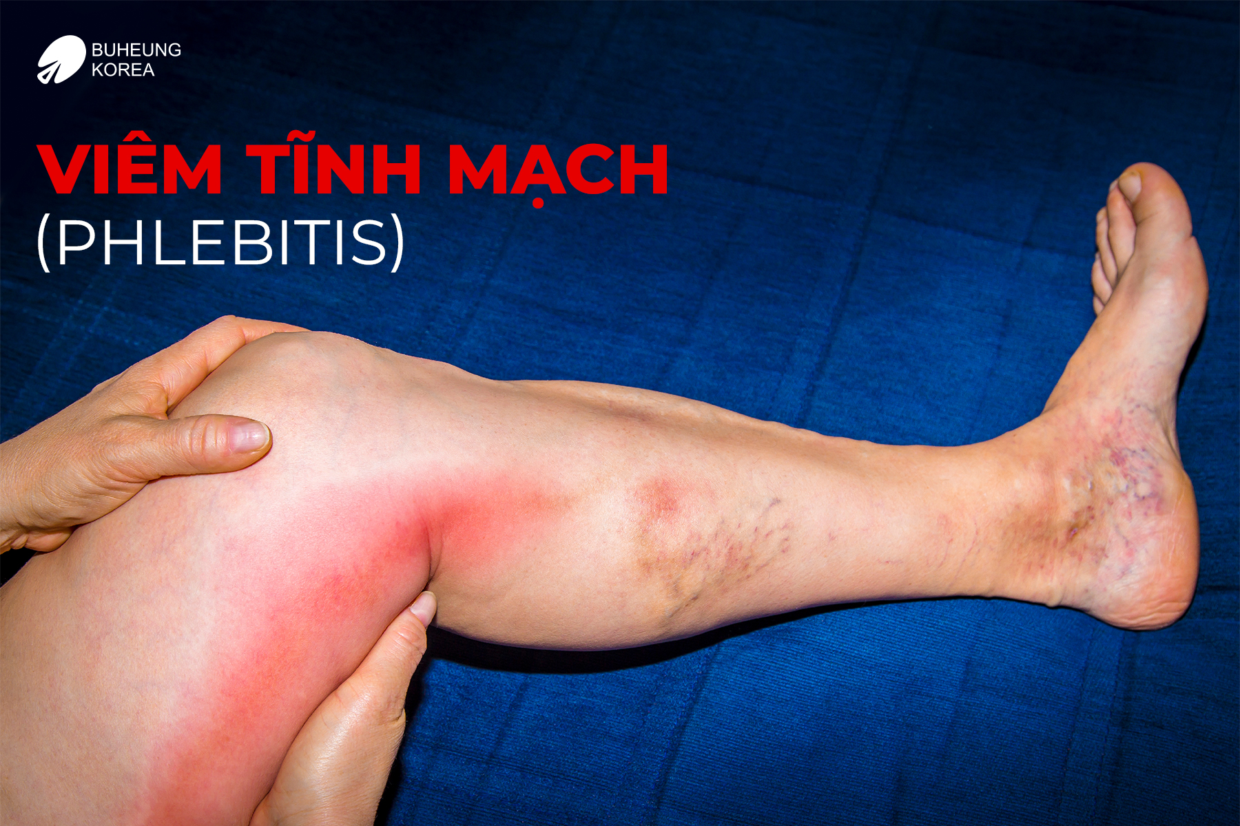 Giãn Tĩnh Mạch Bàn Chân Có Nguy Hiểm Không? 2