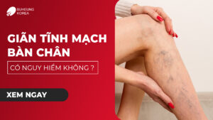 Giãn Tĩnh Mạch Bàn Chân Có Nguy Hiểm Không? 55