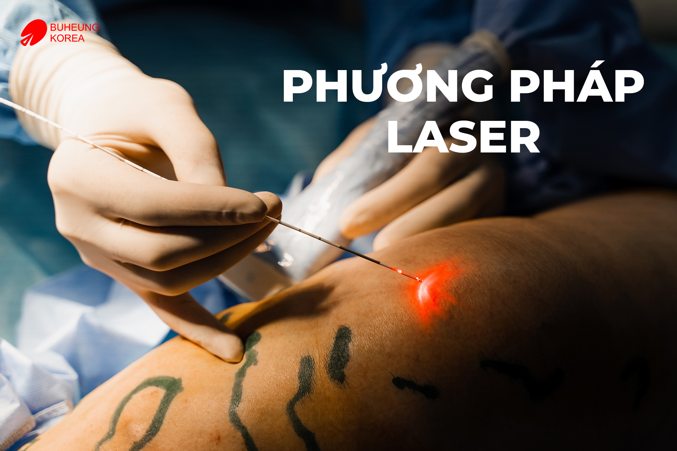 Giãn Tĩnh Mạch Chi Dưới Có Chữa Được Không? 2