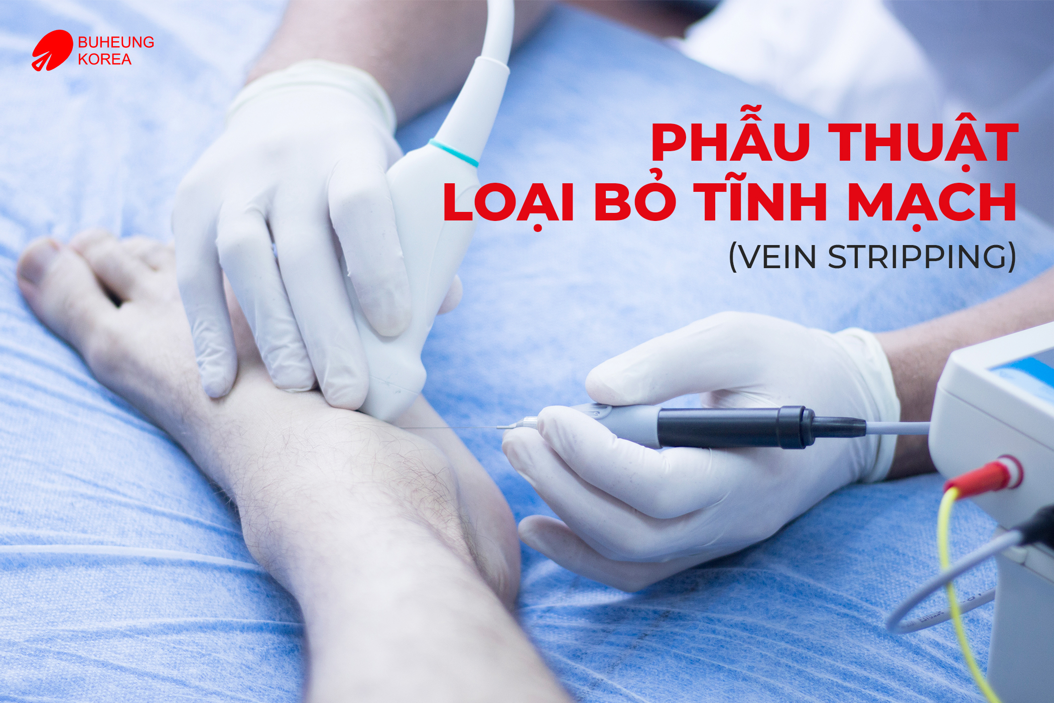 Giãn Tĩnh Mạch Chi Dưới Có Chữa Được Không? 4