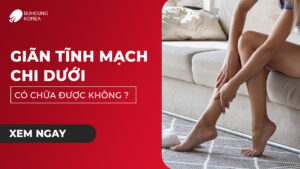 Giãn Tĩnh Mạch Chi Dưới Có Chữa Được Không? 78