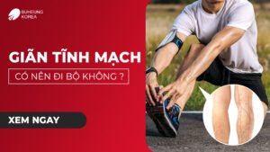 Giãn Tĩnh Mạch Chân Có Nên Đi Bộ Không? 64
