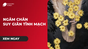 Hướng Dẫn Ngâm Chân Trị Suy Giãn Tĩnh Mạch Hiệu Quả 13