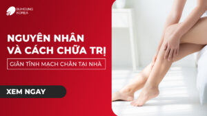 Nguyên Nhân Và Cách Trị Giãn Tĩnh Mạch Chân Tại Nhà 72