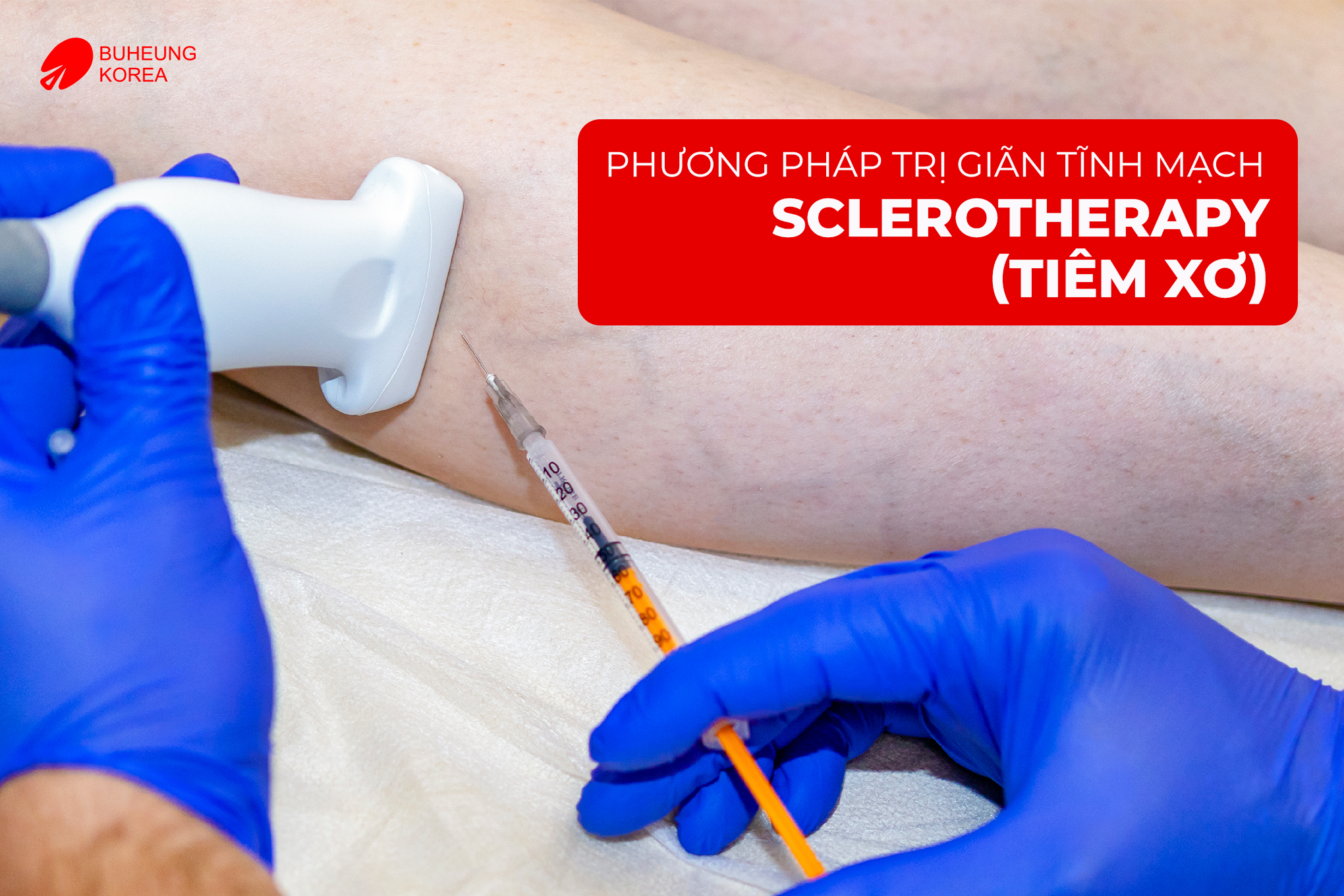 Phác Đồ Điều Trị Giãn Tĩnh Mạch Chi Dưới 2