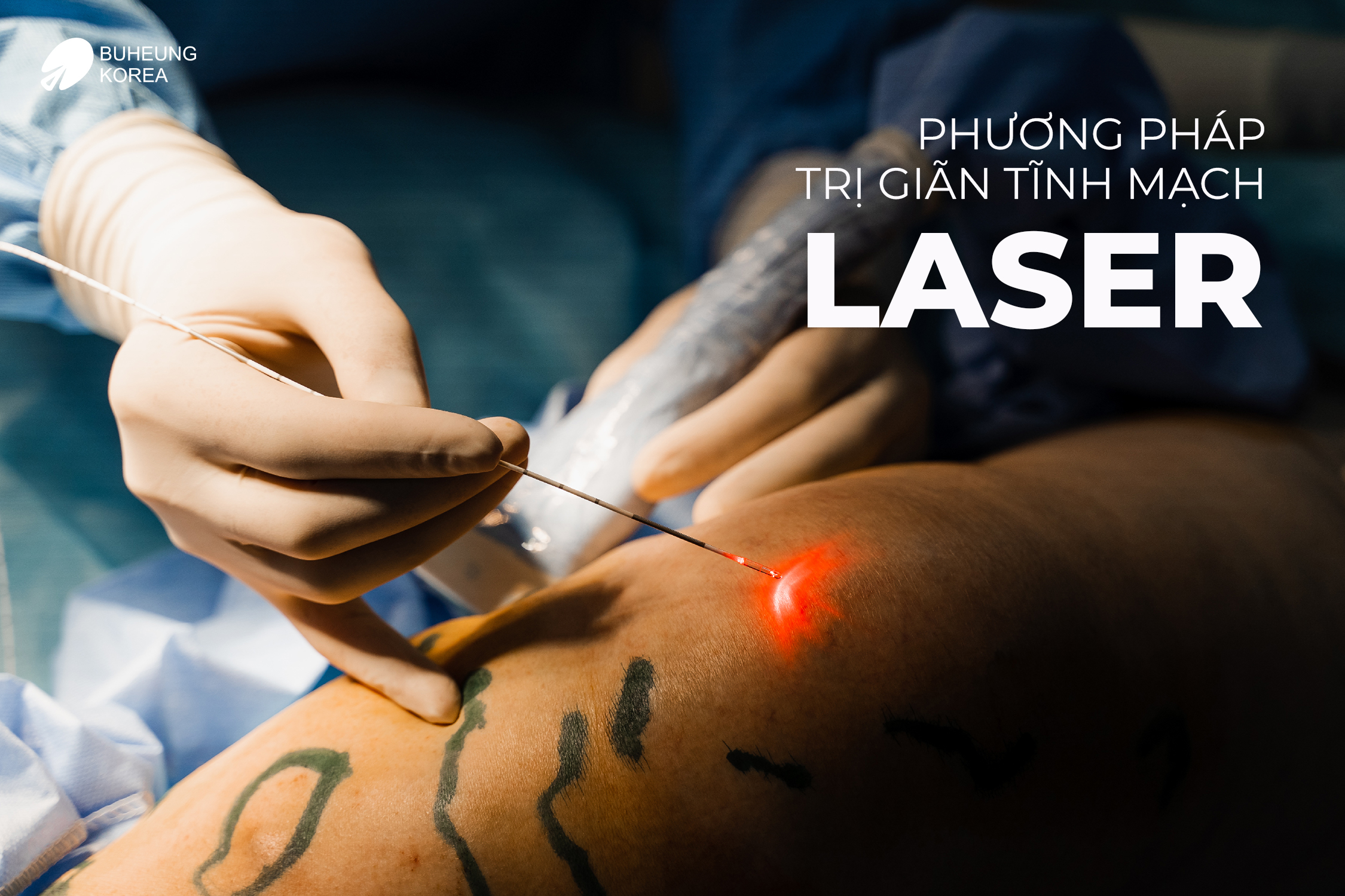 Phác Đồ Điều Trị Giãn Tĩnh Mạch Chi Dưới 3