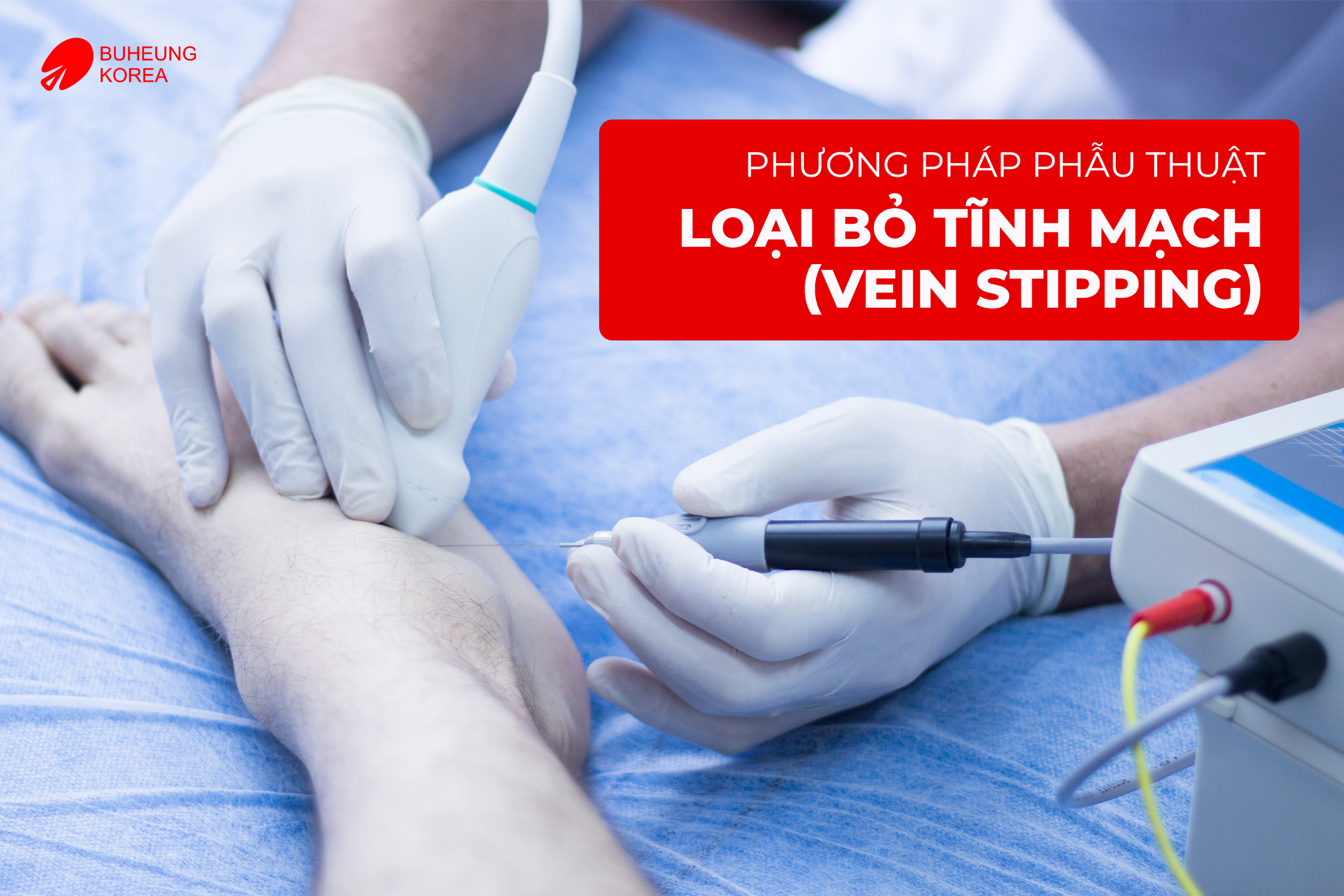Phác Đồ Điều Trị Giãn Tĩnh Mạch Chi Dưới 4