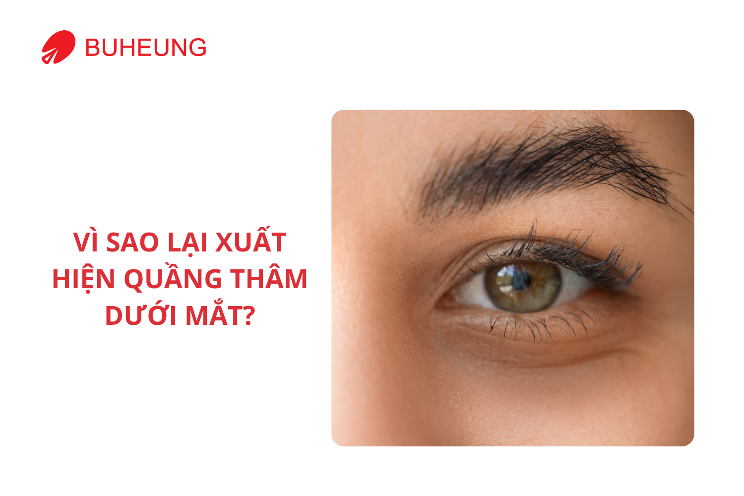 Nguyên Nhân Gây Quầng Thâm Và Cách Massage Giúp Làm Mờ Hiệu Quả 1 Nguyên Nhân Gây Quầng Thâm Và Cách Massage Giúp Làm Mờ Hiệu Quả 1